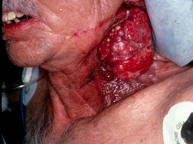 Here is a smoker whose cancerous tumor started in his mouth and moved to his neck before killing him.